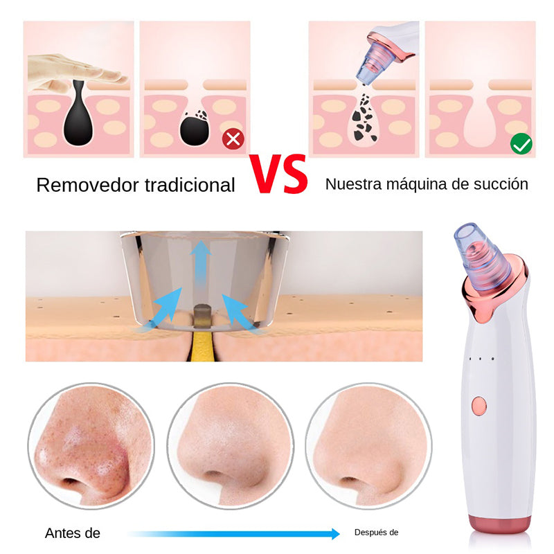 Professional Pore Vacuum & Blackhead Remover | 5-in-1 Facial Treatment