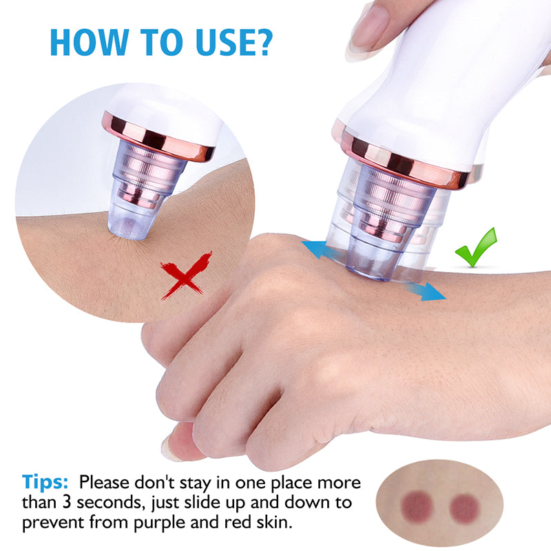 Professional Pore Vacuum & Blackhead Remover | 5-in-1 Facial Treatment